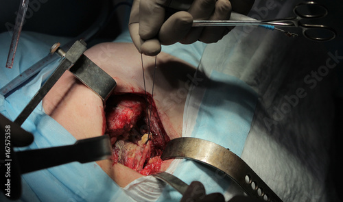 Surgeon pulls the nerve by thread defending it during the hip replacement surgery close up