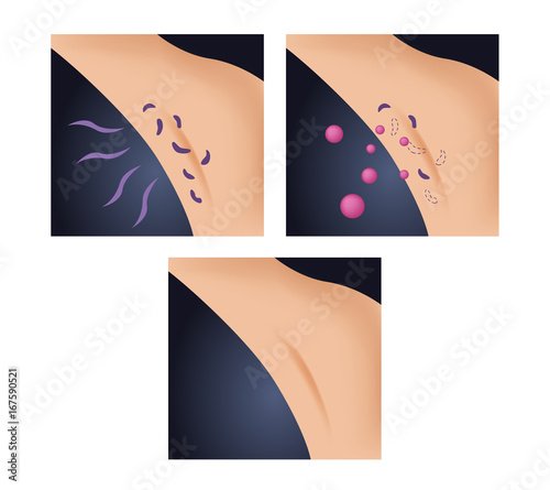 a medicine kill armpit bacteria and make a nice smell