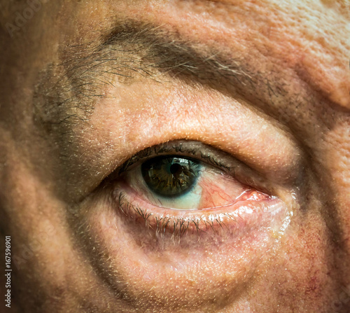 Close up of the eye with pseudopterygium after one year of conjunctiva squamous cell carcinoma surgical removal photo