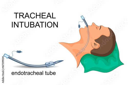 intubation of the trachea. artificial ventilation of the lungs photo