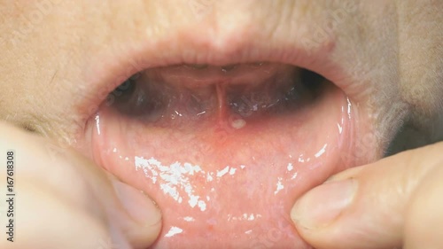 Close-up of stomatitis into mouth. Woman bends his lower lip and shows stomatitis