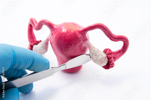 Ovarian gynecologic surgery concept. Hand of surgeon with scalpel near female genitals symbolizes surgical intervention such as cancer, removing ovaries and tubes, cysts and cystectomy as treatment photo