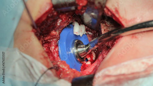 Orthopedic pusher use to push cement into the bottom of articular cavity