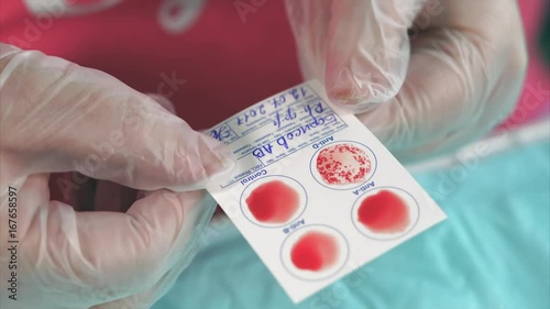 Result of blood type test by express method. Doctor finishing mixing test samples on testing panel. Close up view