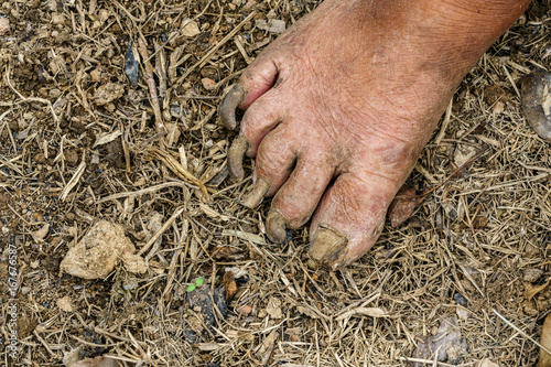 Toenails disease in old male gardener on the ground