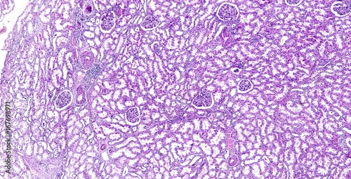 Arteriolar hyaline degeneration of kidney of a human