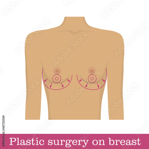 Plastic surgery breast augmentation infographic. Scheme of surgical breast augmentation. Correction of bust size in the form of a vector illustration