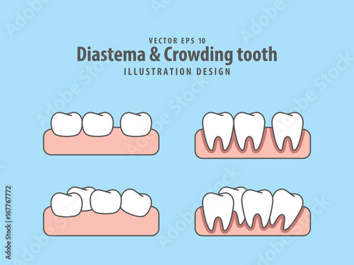 Diastema & Crowding tooth illustration vector on blue background. Dental concept.