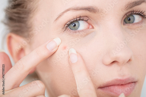 Young woman about to squeeze spot