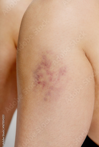 Bruise on skin.
