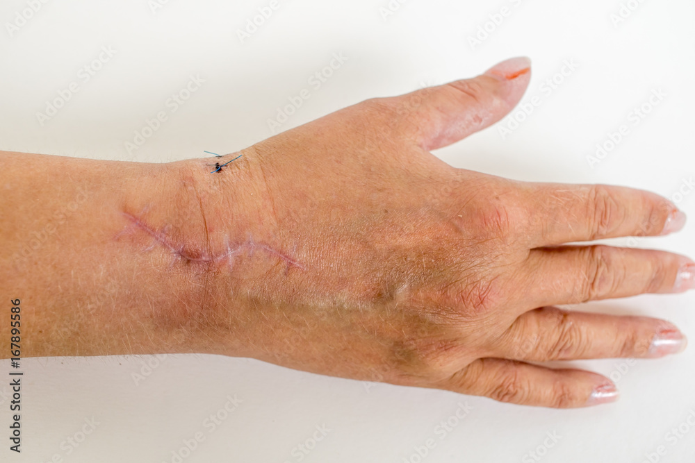Fototapeta premium Narben am Handgelenk, Radiusfraktur