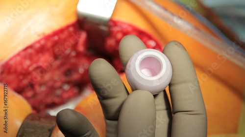 Ceramic hip head in surgeons fingers close up during the hip replacement surgery