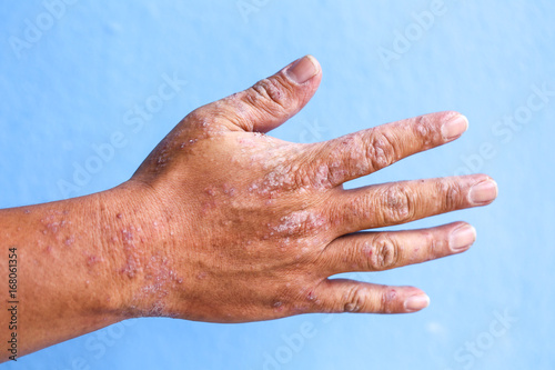 Atopic dermatitis (AD), also known as atopic eczema, is a type of inflammation of the skin (dermatitis).