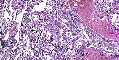 Fotografi Histology of human tissue, show chronic congestion of lung as seen under the mic