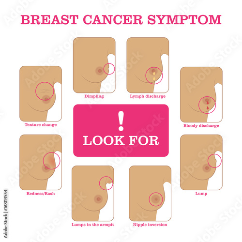 Breast cancer symptoms infographic. Methods for detecting breast cancer using self-testing for designers and illustrators. Timely care of woman health in the form of a vector illustration
