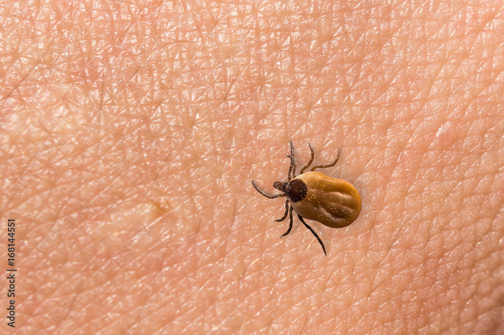 Tick filled with blood crawling on human body skin Tick filled with blood crawling on human body skin