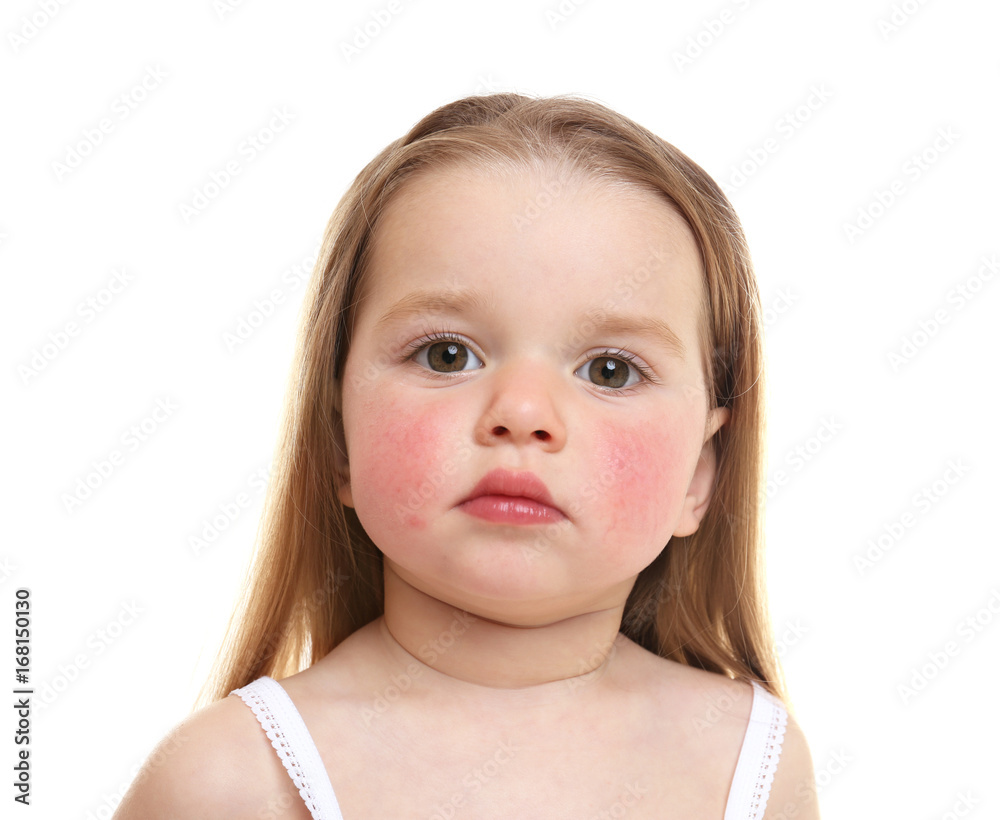 Portrait of little girl with diathesis symptoms on cheeks, against white background Portrait of little girl with diathesis symptoms on cheeks, against white background