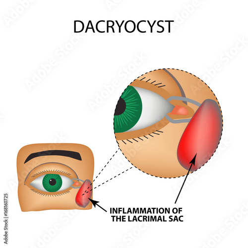 Fototapeta Naklejka Na Ścianę i Meble -  Dacryocyst. Inflammation of the lacrimal sac of the eye. The structure of the eye. Infographics. Vector illustration on isolated background