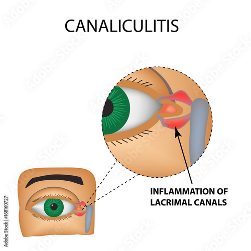 Canaliculitis. Inflammation of lacrimal canals. The structure of the eye. Infographics. Vector illustration on isolated background