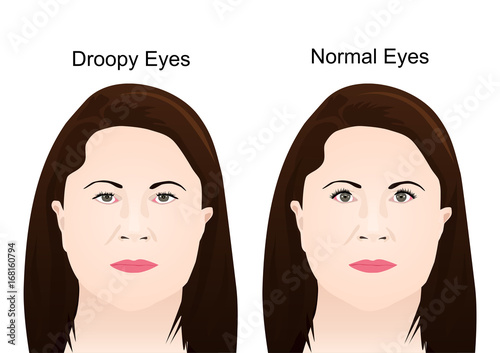 Droopy Eyelid's Surgery