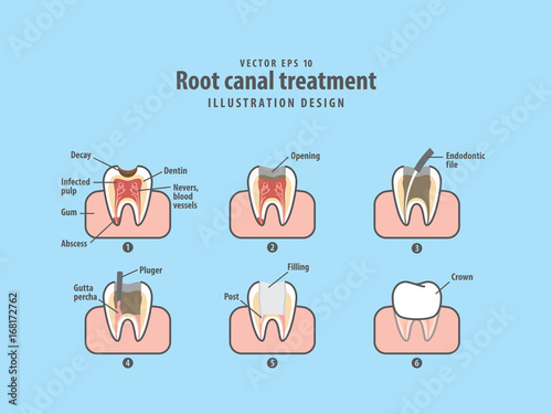 Root canal treatment illustration vector on blue background. Dental concept.
