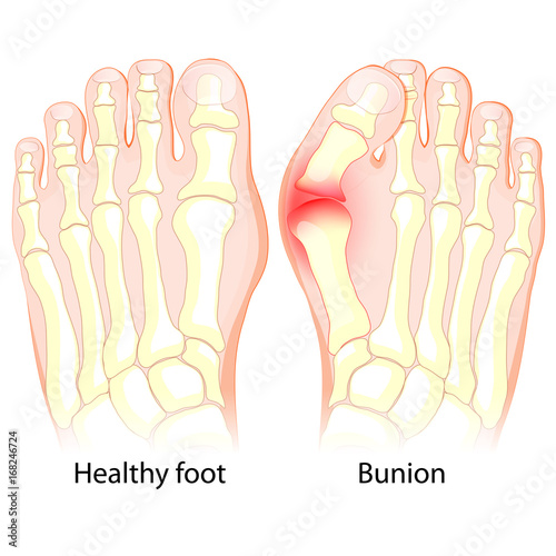 Bunion. Human anatomy. Skeleton