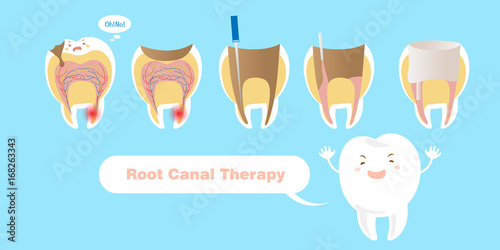 tooth with root canal therapy