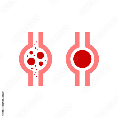 Thrombus