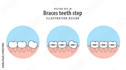 Braces teeth step in circle illustration vector on white background. Dental concept.