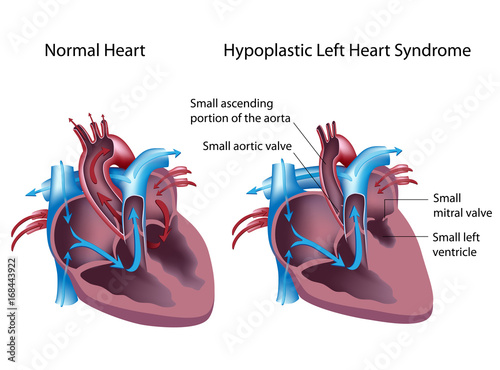 Hypoplastic left heart syndrome photo