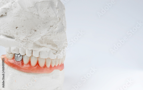 Wallpaper Mural Artificial tooth, dental prosthesis with false silver tooth, metalic crown on tooth. Torontodigital.ca