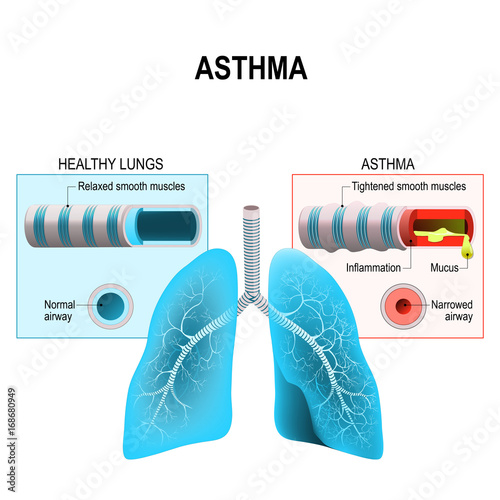 Asthma. Humans lungs and bronchi