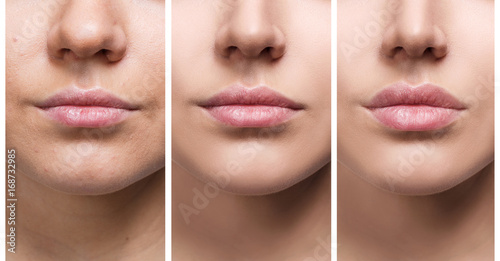 Lips of young woman before and after augmentation photo