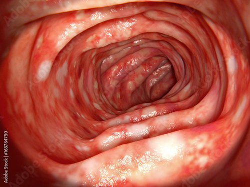 Colitis ulcerosa. Sie ist eine chronisch-entzündliche Darmerkrankung photo