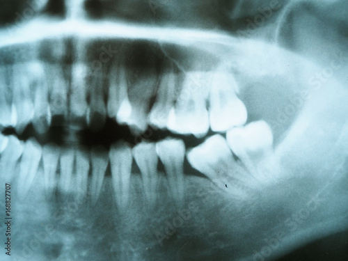 X-Ray film showing teeth 