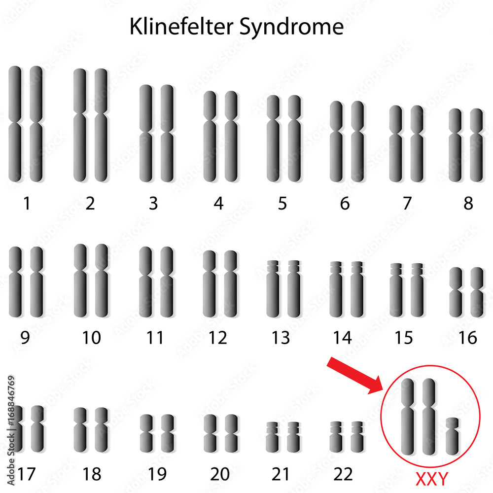 Klinefelter syndrome Stock Illustration Adobe Stock