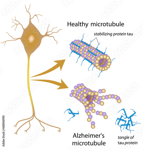 Disintegrating microtubules in Alzheimer's photo