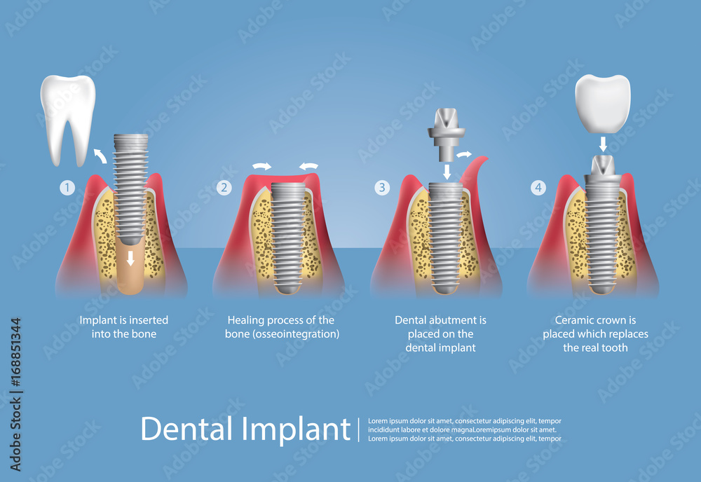 Human teeth and Dental implant Vector Illustration - obrazy, fototapety, plakaty 