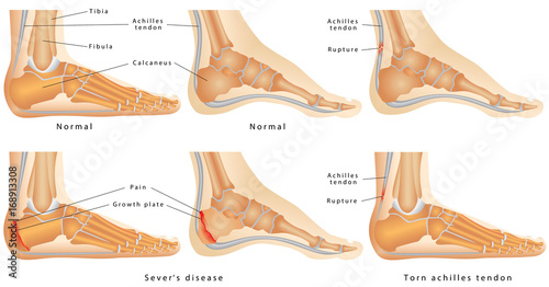 Ankle, Calcaneal Apophysitis, Achilles tendon
