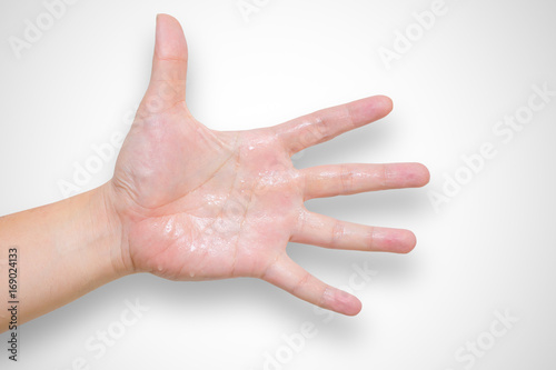 Hyperhidrosis wet hand from sweat syndrome photo