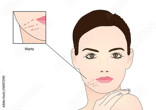 Flat Warts on Face