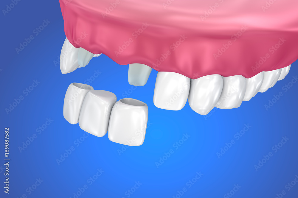 Obraz premium Tooth supported fixed bridge. Medically accurate 3D illustration