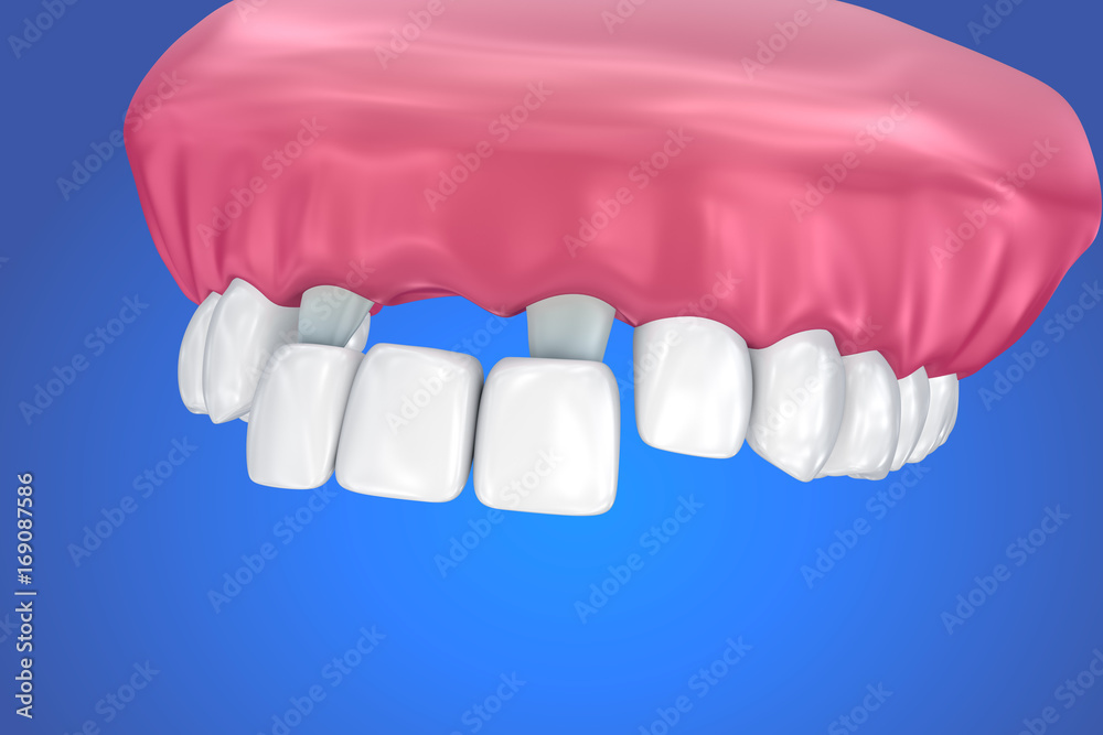 Obraz premium Tooth supported fixed bridge. Medically accurate 3D illustration