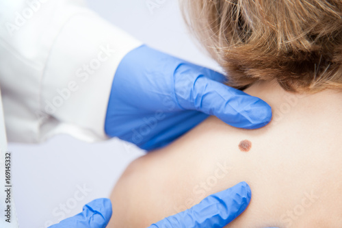 birthmark / A medical consultation at the Removal of nevus.
