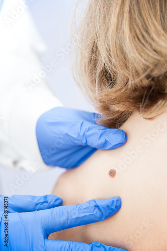 birthmark / A medical consultation at the Removal of nevus.
