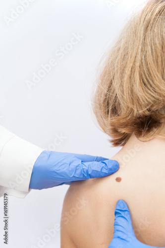 birthmark / A medical consultation at the Removal of nevus.
