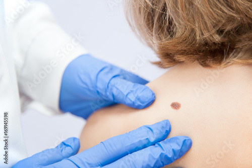 birthmark / A medical consultation at the Removal of nevus.
