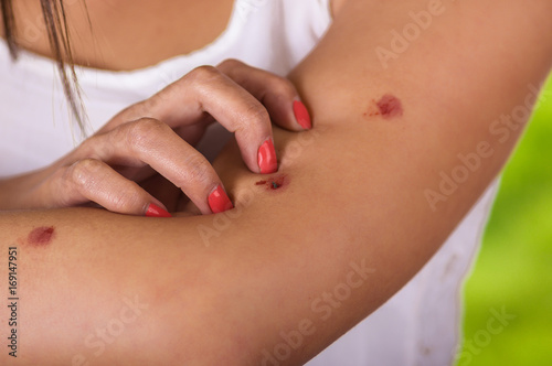 Close up of young woman suffering from itch after mosquito bites  in a blurred background