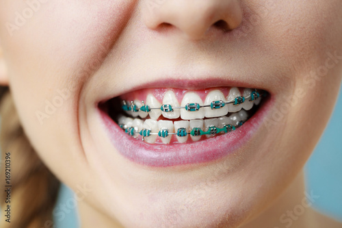 Closeup of woman teeth with braces, funny face