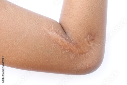 Scar on the arm isolated on white background